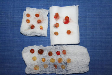 摘出した水晶体（まるでキャンディー）